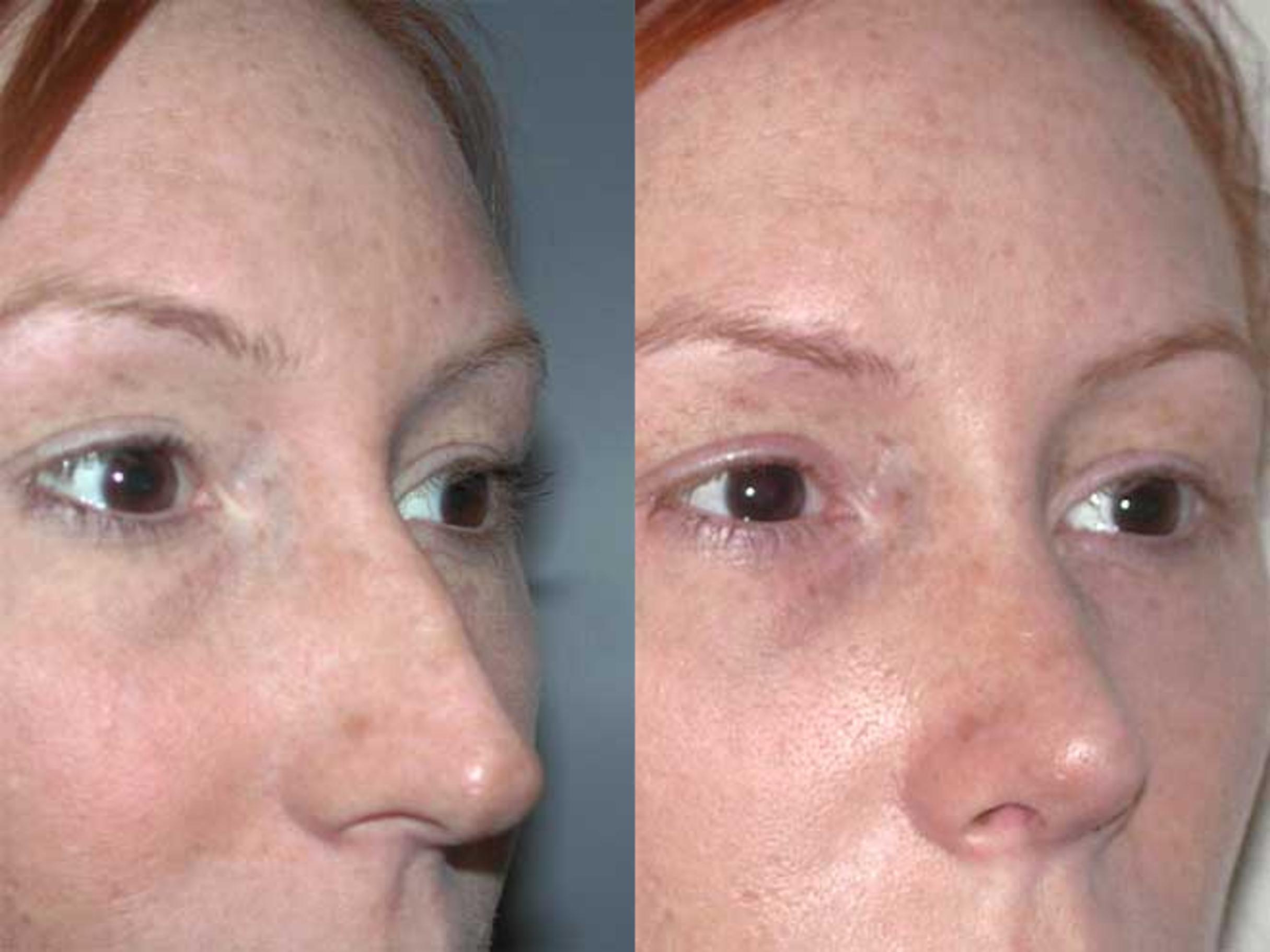 Before & After Rhinoplasty Case 28 View #2 View in Albany, Latham & Saratoga, New York