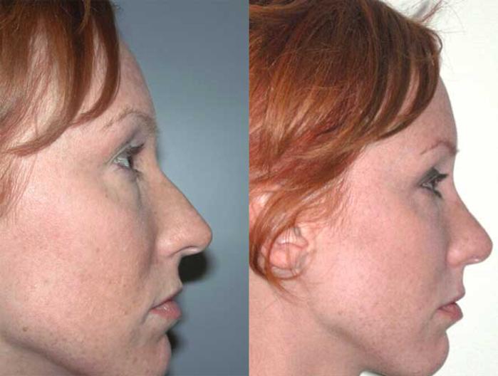 Before & After Rhinoplasty Case 28 View #3 View in Albany, Latham & Saratoga, New York