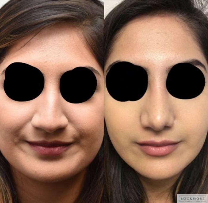 Before & After Rhinoplasty Case 316 View #1 View in Albany, Latham & Saratoga, New York