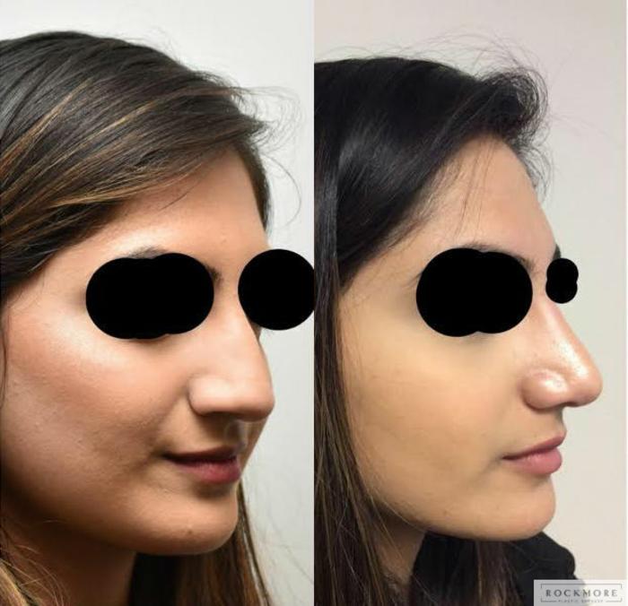 Before & After Rhinoplasty Case 316 View #2 View in Albany, Latham & Saratoga, New York