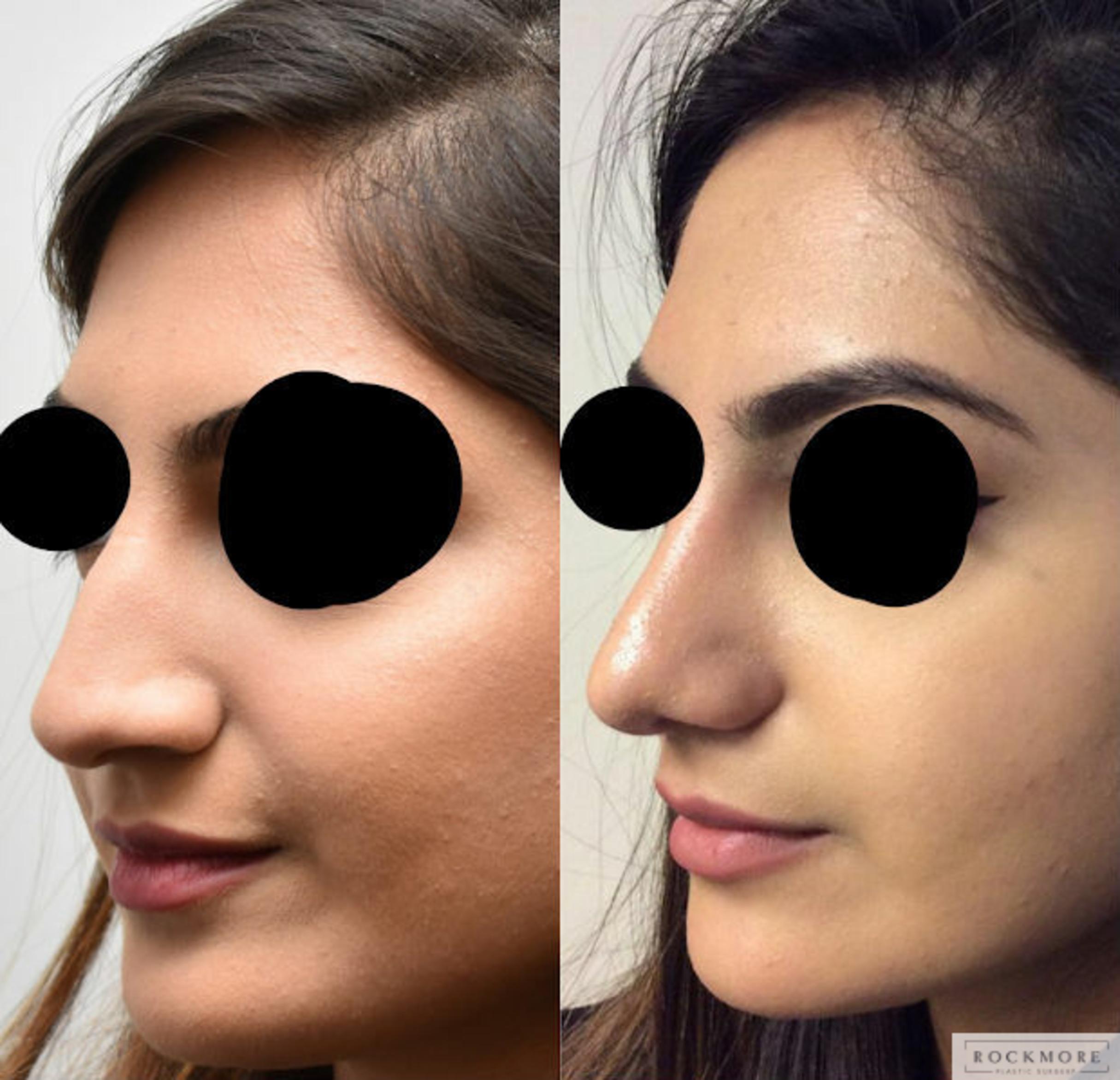 Before & After Rhinoplasty Case 316 View #3 View in Albany & Latham, New York