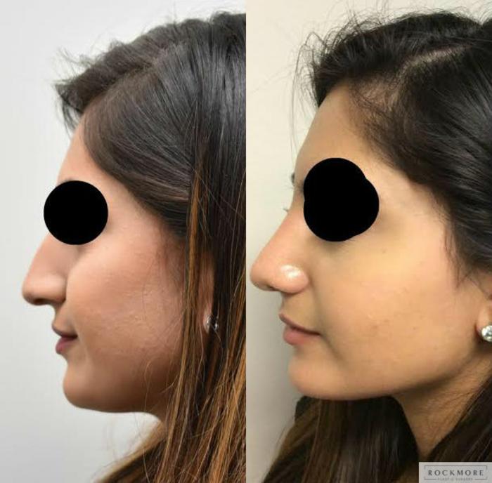 Before & After Rhinoplasty Case 316 View #4 View in Albany, Latham & Saratoga, New York