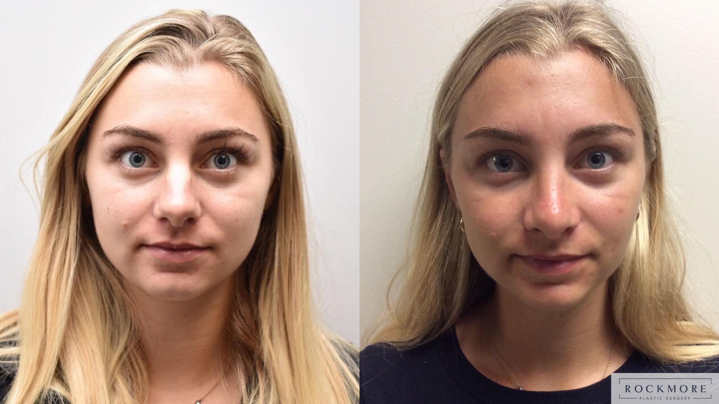 Rhinoplasty Before & After Photos Patient 322 Albany & Latham, New York Rockmore Plastic Surgery