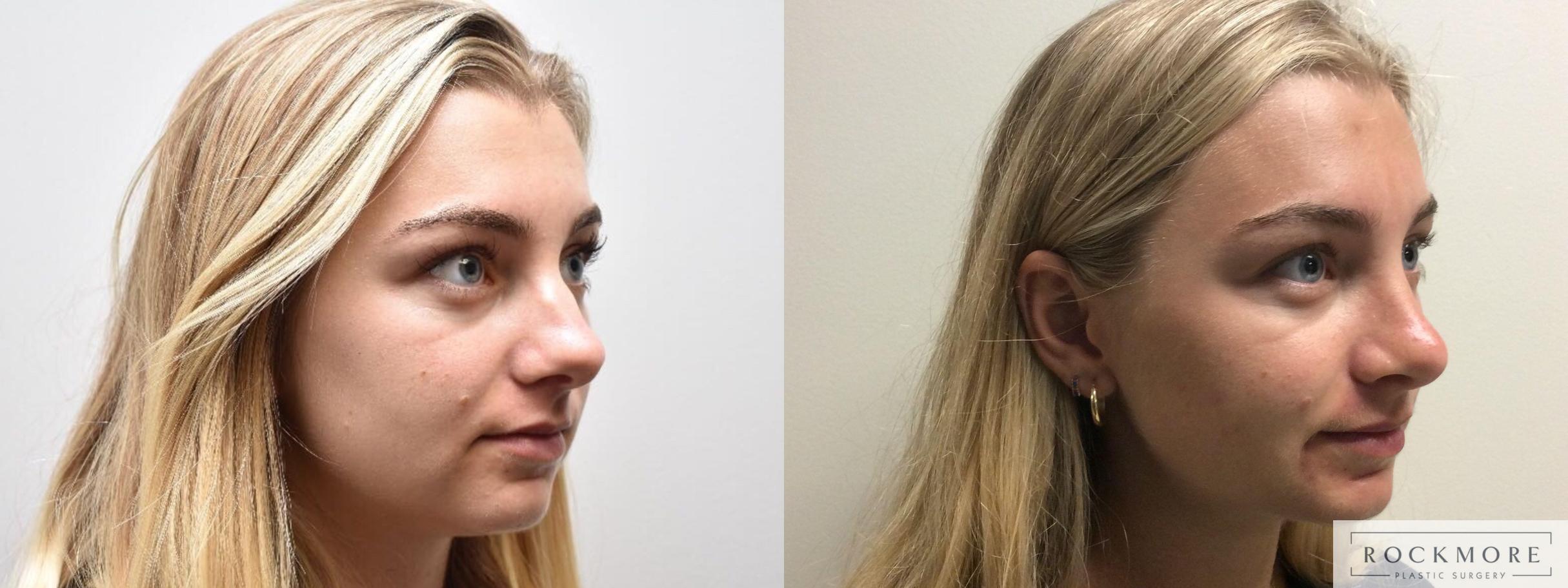 Before & After Rhinoplasty Case 322 Right Oblique View in Albany & Latham, New York