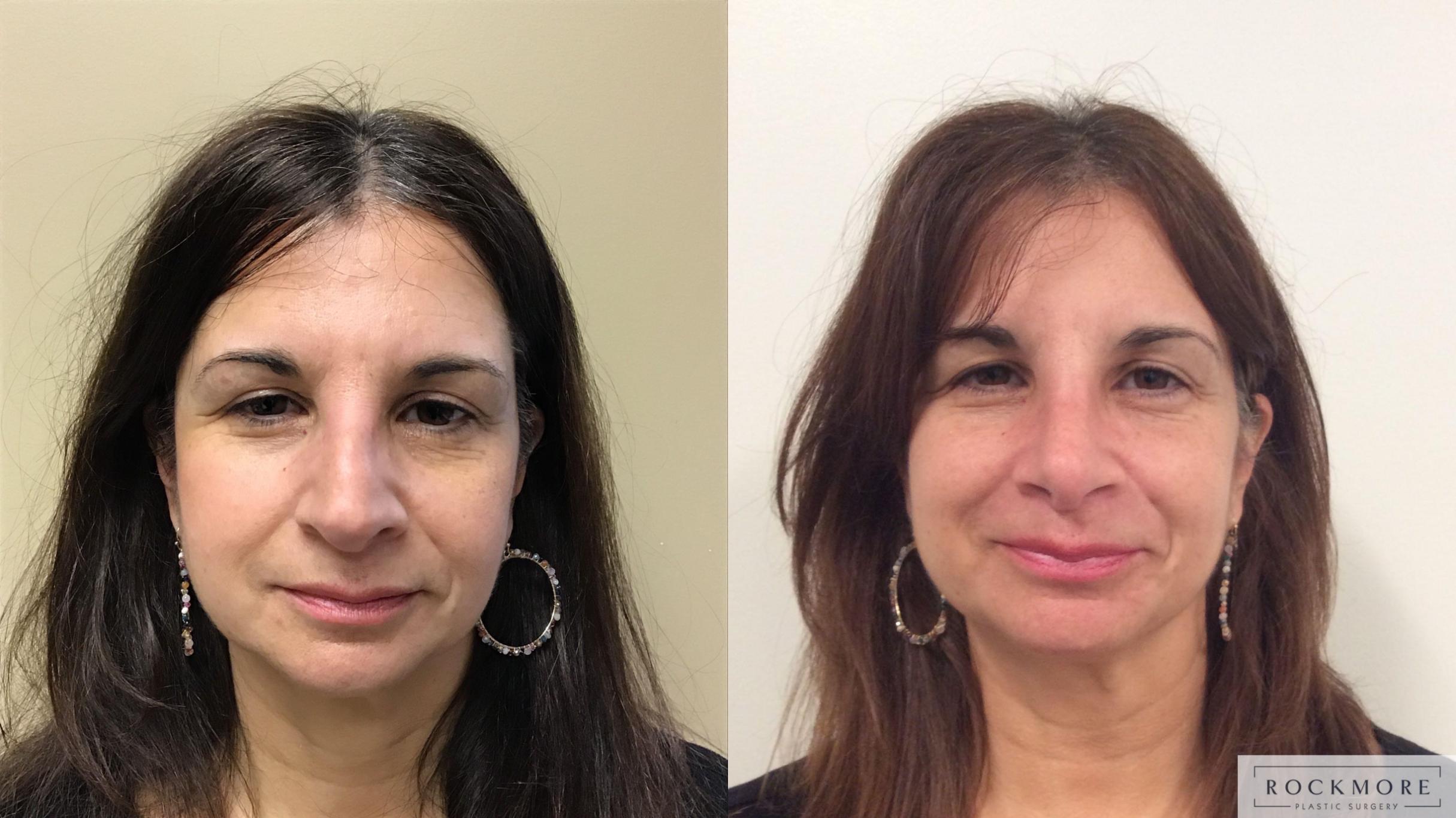 Before & After Rhinoplasty Case 323 Front View in Albany & Latham, New York