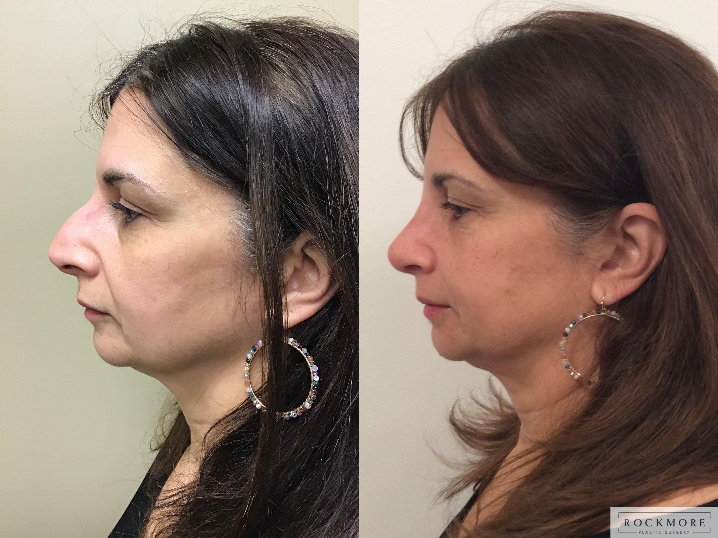 Before & After Rhinoplasty Case 323 Left Side View in Albany & Latham, New York