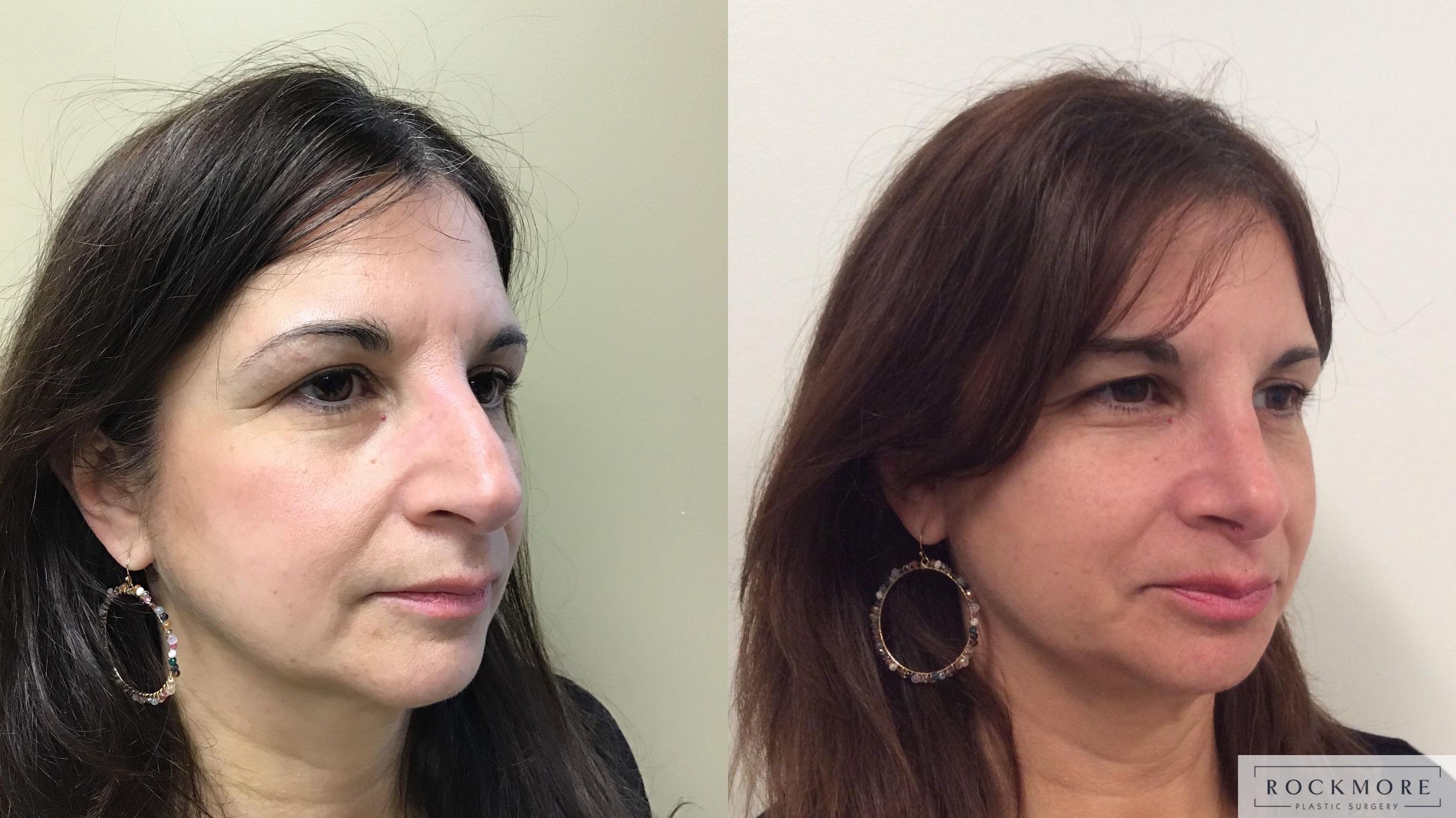 Before & After Rhinoplasty Case 323 Right Oblique View in Albany & Latham, New York