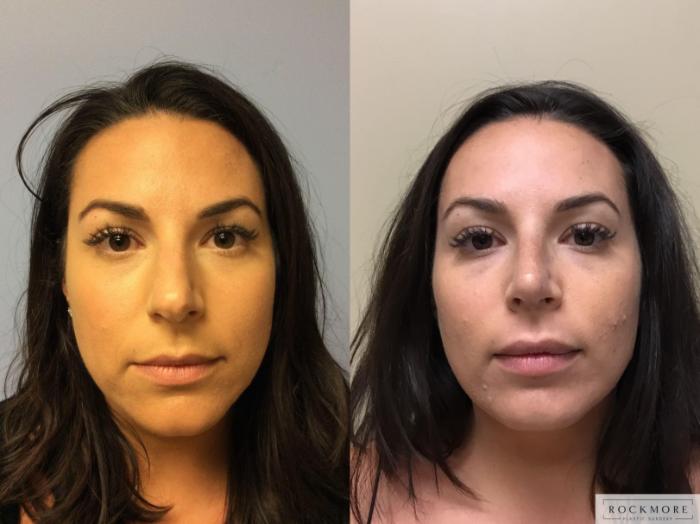 Before & After Rhinoplasty Case 348 Front View in Albany & Latham, New York