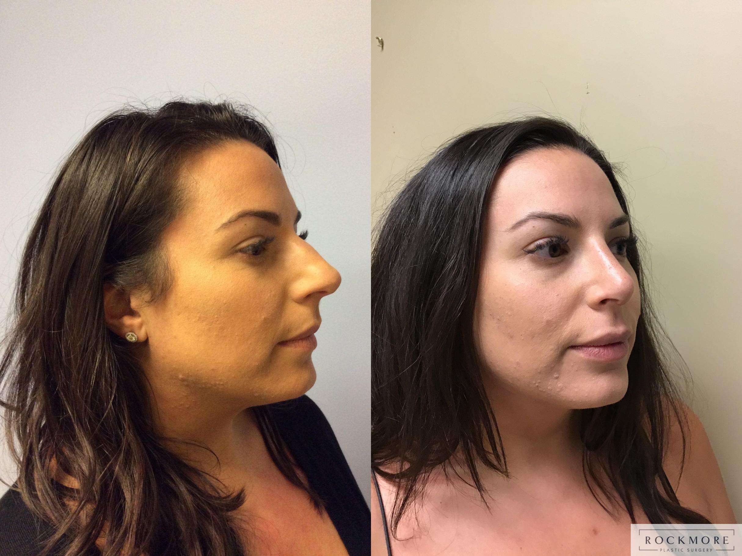 Before & After Rhinoplasty Case 348 Left Oblique View in Albany & Latham, New York