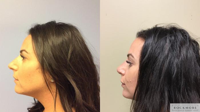 Before & After Rhinoplasty Case 348 Left Side View in Albany & Latham, New York