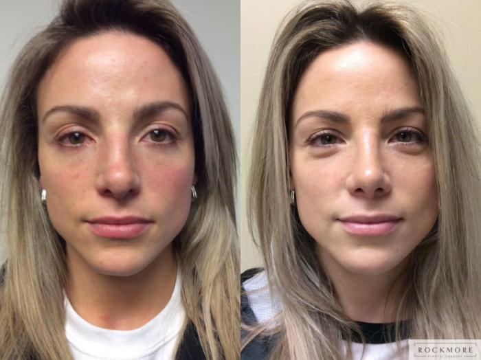 Before & After Rhinoplasty Case 349 Front View in Albany & Latham, New York