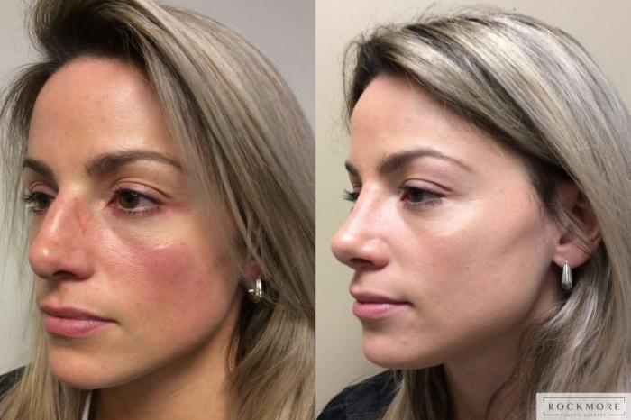 Before & After Rhinoplasty Case 349 Right Oblique View in Albany & Latham, New York