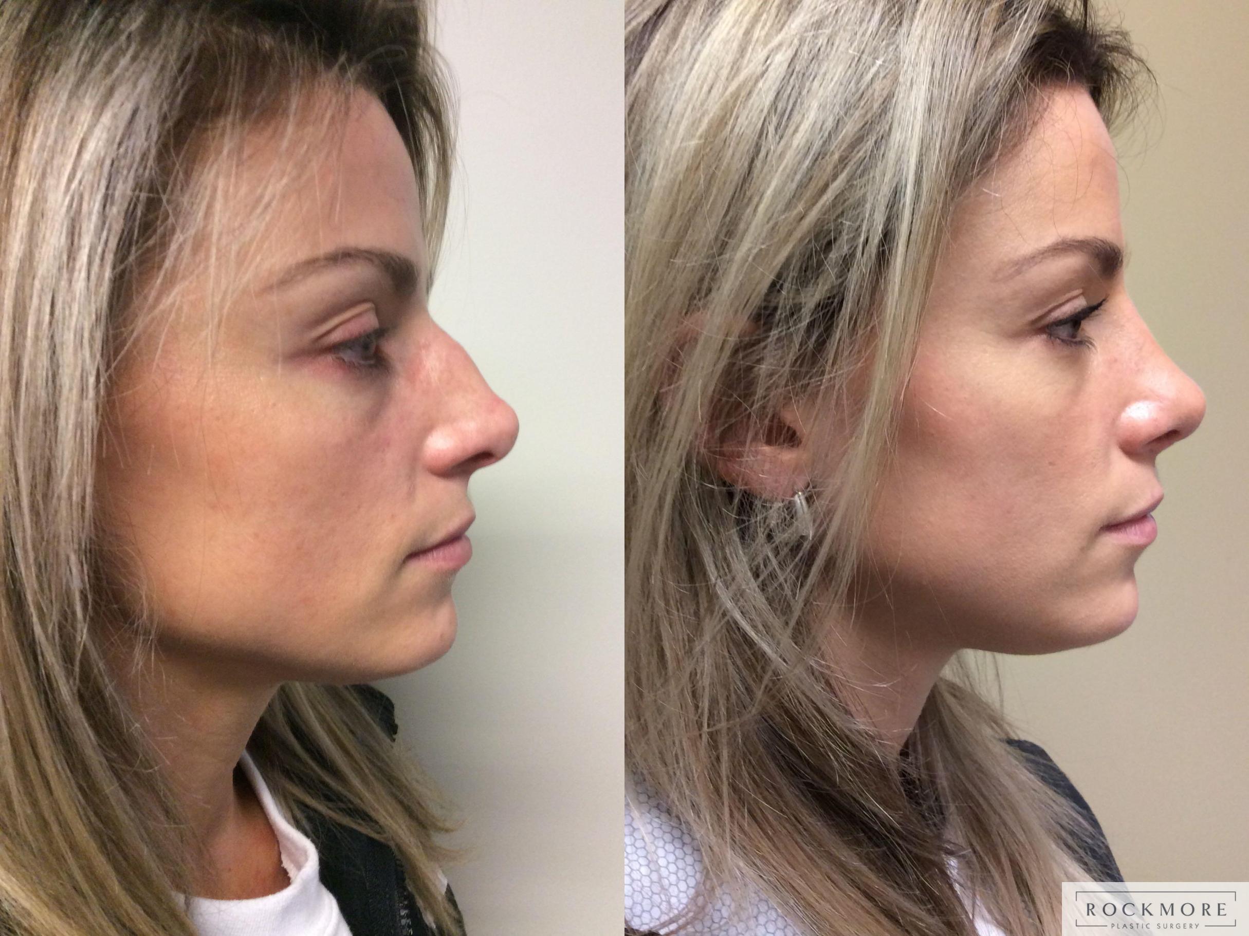 Before & After Rhinoplasty Case 349 Right Side View in Albany & Latham, New York