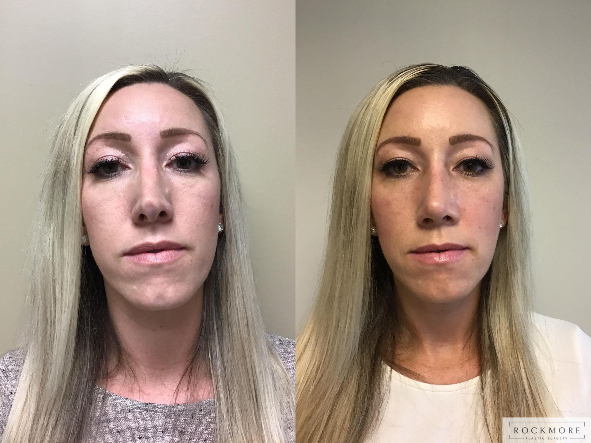 Before & After Rhinoplasty Case 350 Front View in Albany & Latham, New York