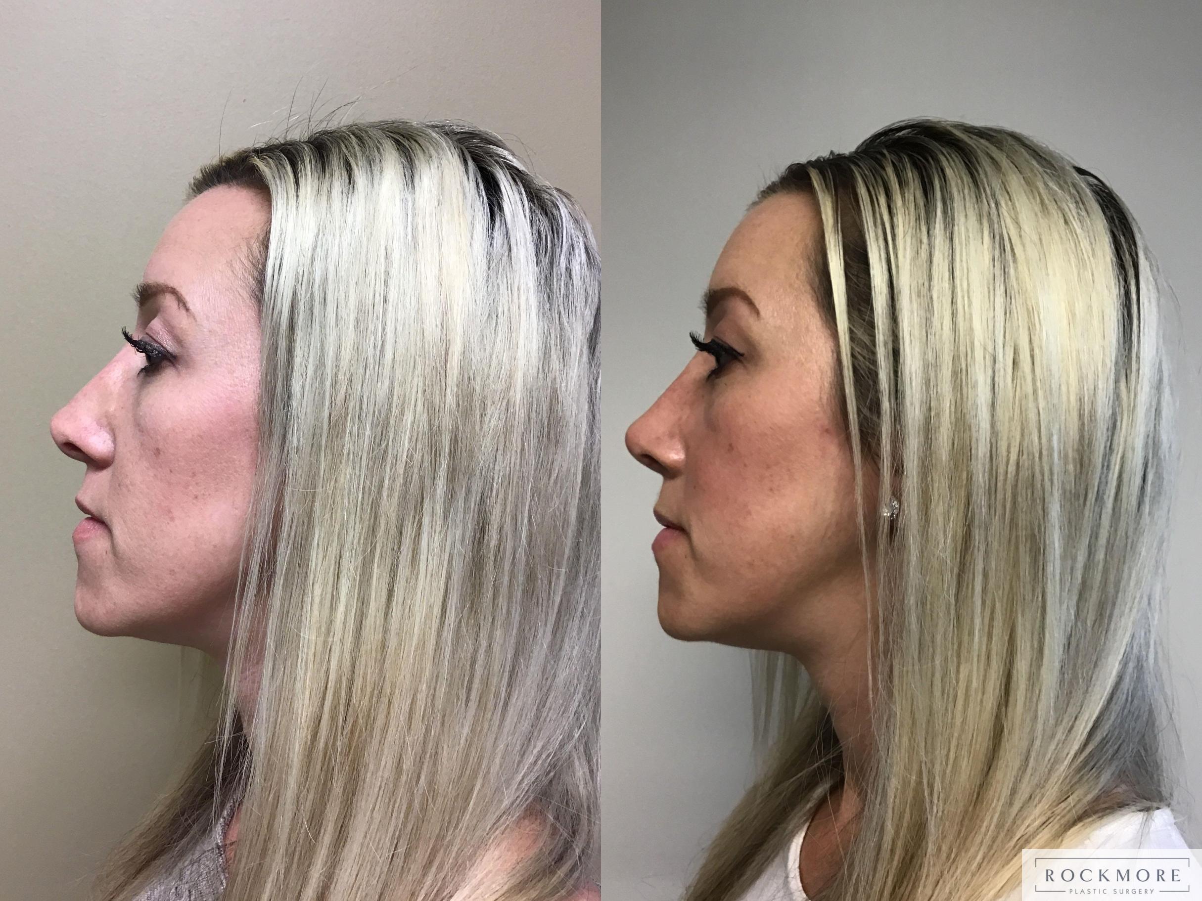 Before & After Rhinoplasty Case 350 Left Side View in Albany & Latham, New York