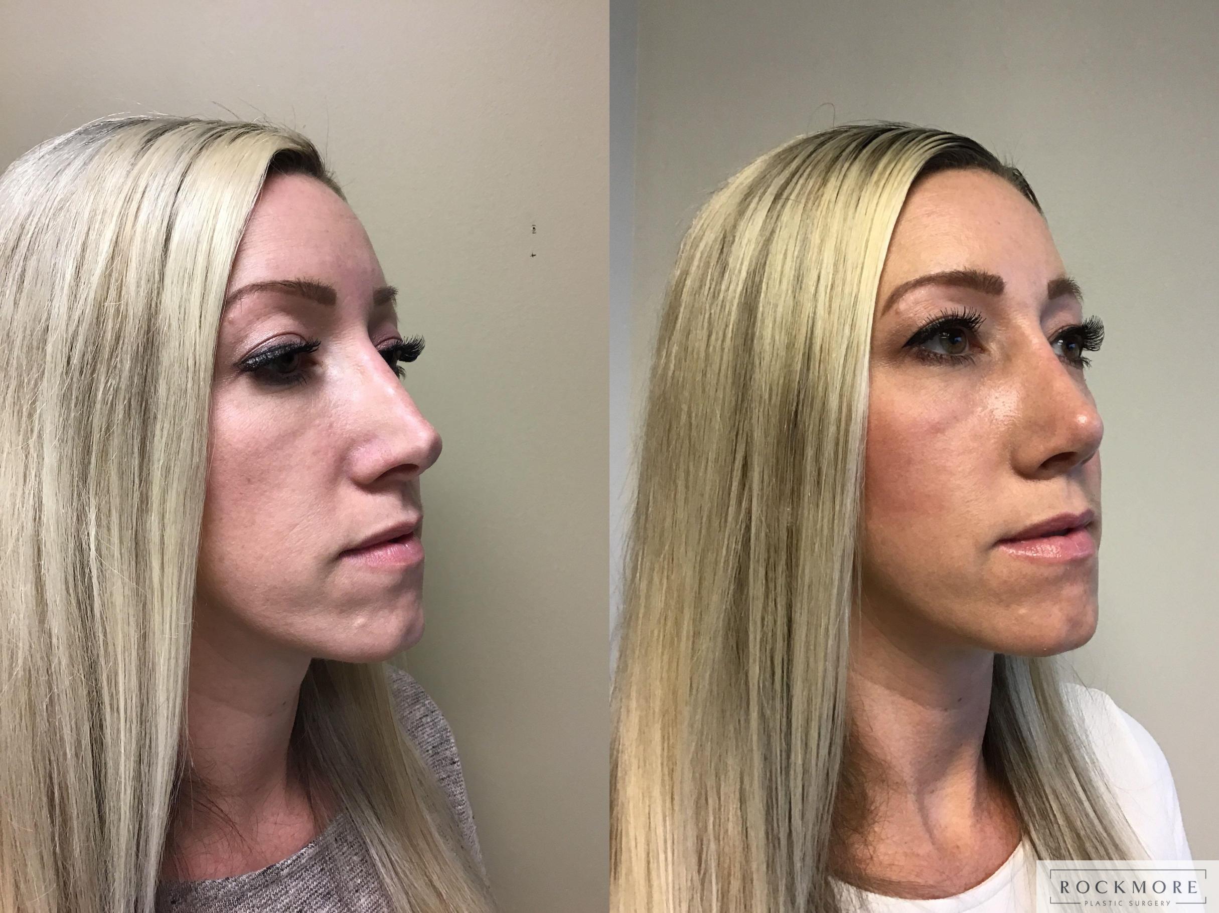 Before & After Rhinoplasty Case 350 Right Oblique View in Albany & Latham, New York