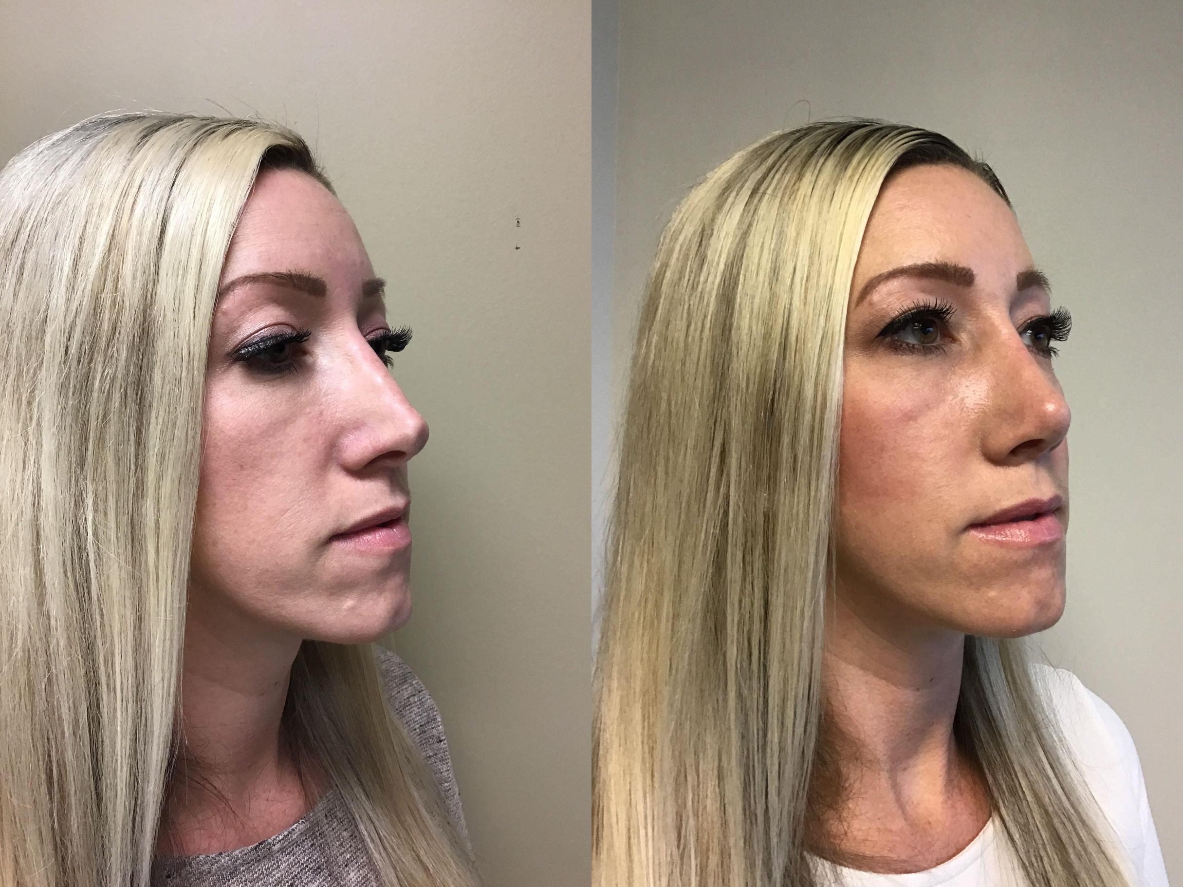 Before & After Rhinoplasty Case 350 Right Oblique View in Albany & Latham, New York