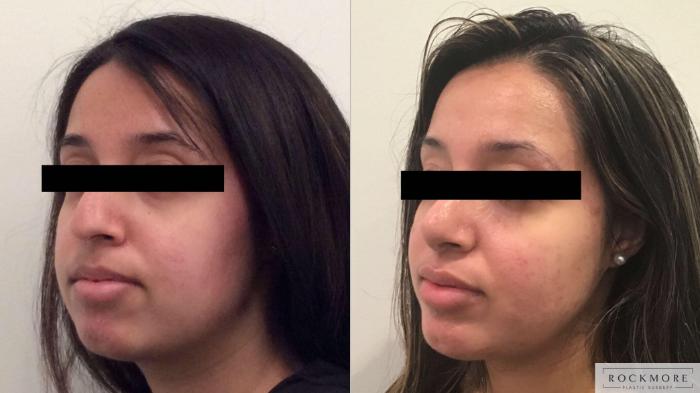 Before & After Rhinoplasty Case 385 Left Oblique View in Albany & Latham, New York