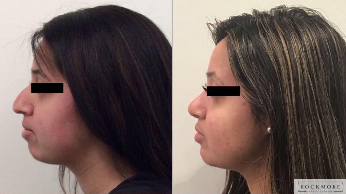 Before & After Rhinoplasty Case 385 Left Side View in Albany & Latham, New York