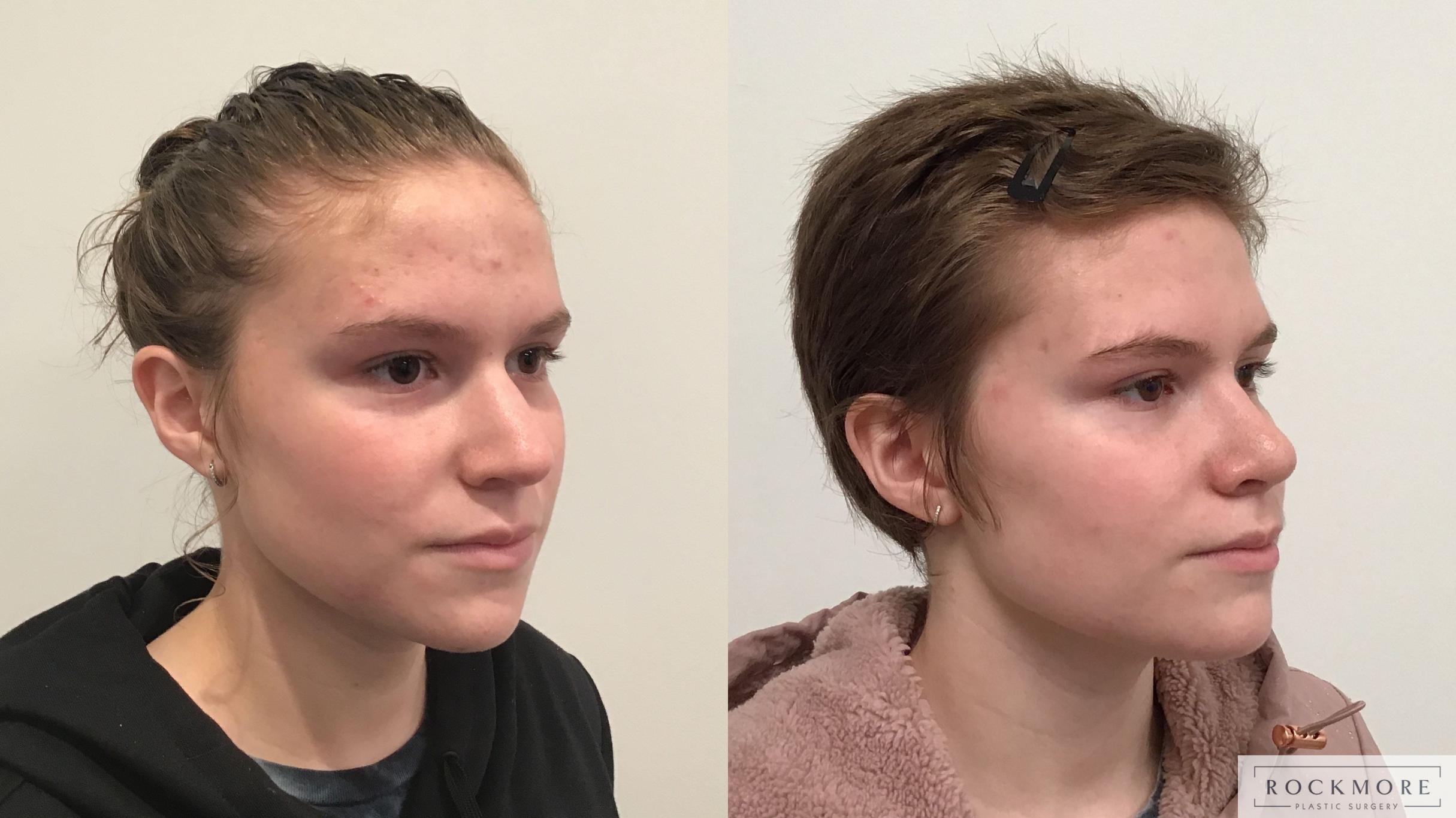 Before & After Rhinoplasty Case 410 Right Oblique View in Albany & Latham, New York