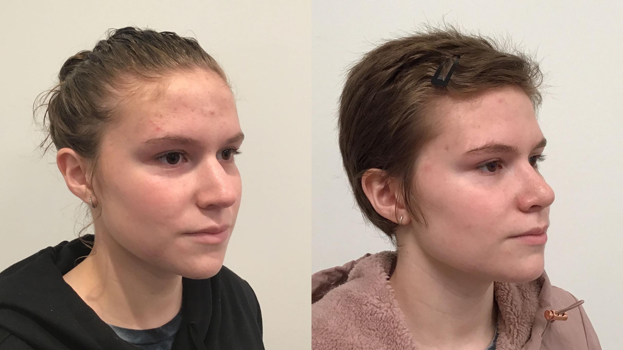 Before & After Rhinoplasty Case 410 Right Oblique View in Albany, Latham & Saratoga, New York