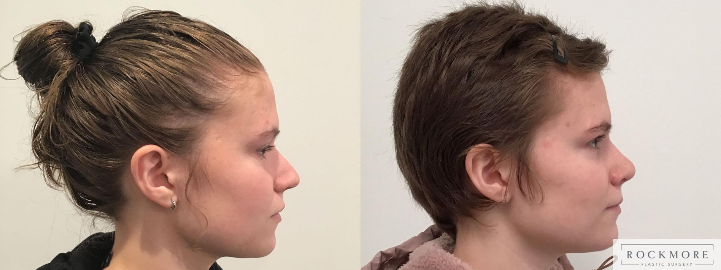 Before & After Rhinoplasty Case 410 Right Side View in Albany & Latham, New York