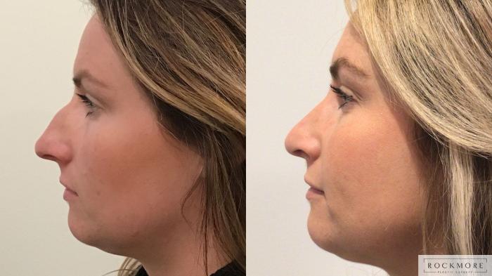Before & After Rhinoplasty Case 442 Front View in Albany & Latham, New York