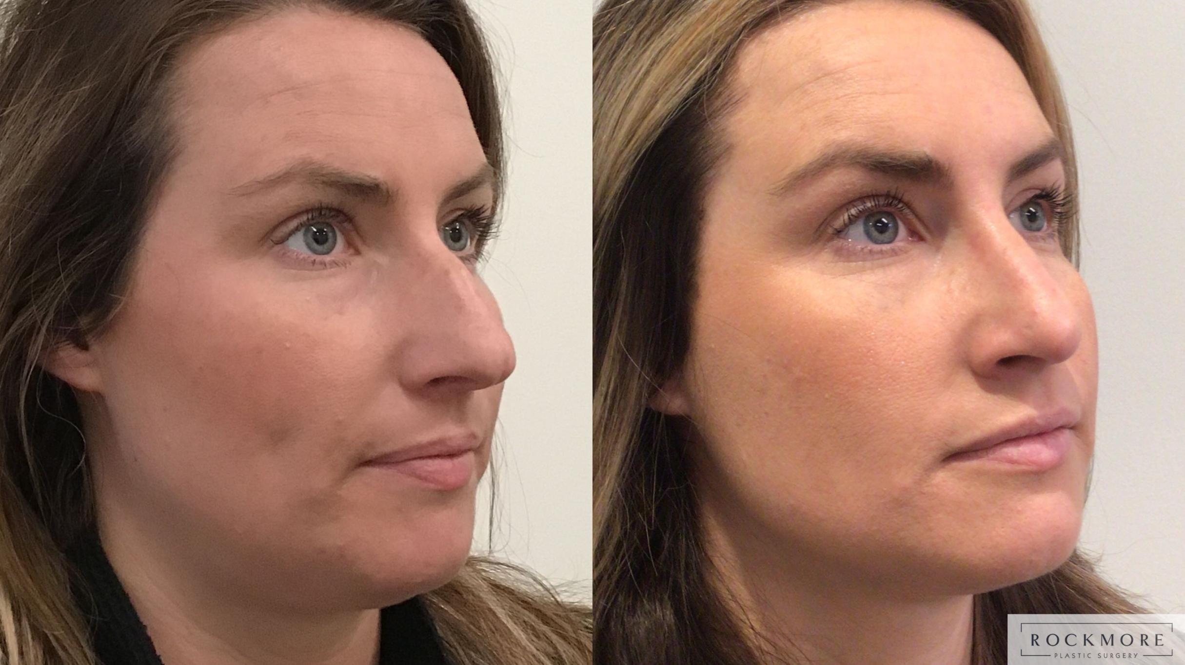 Before & After Rhinoplasty Case 442 Left Side View in Albany & Latham, New York