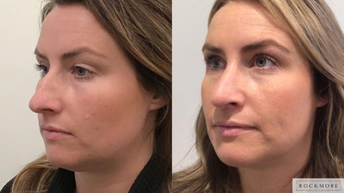 Before & After Rhinoplasty Case 442 Right Side View in Albany & Latham, New York