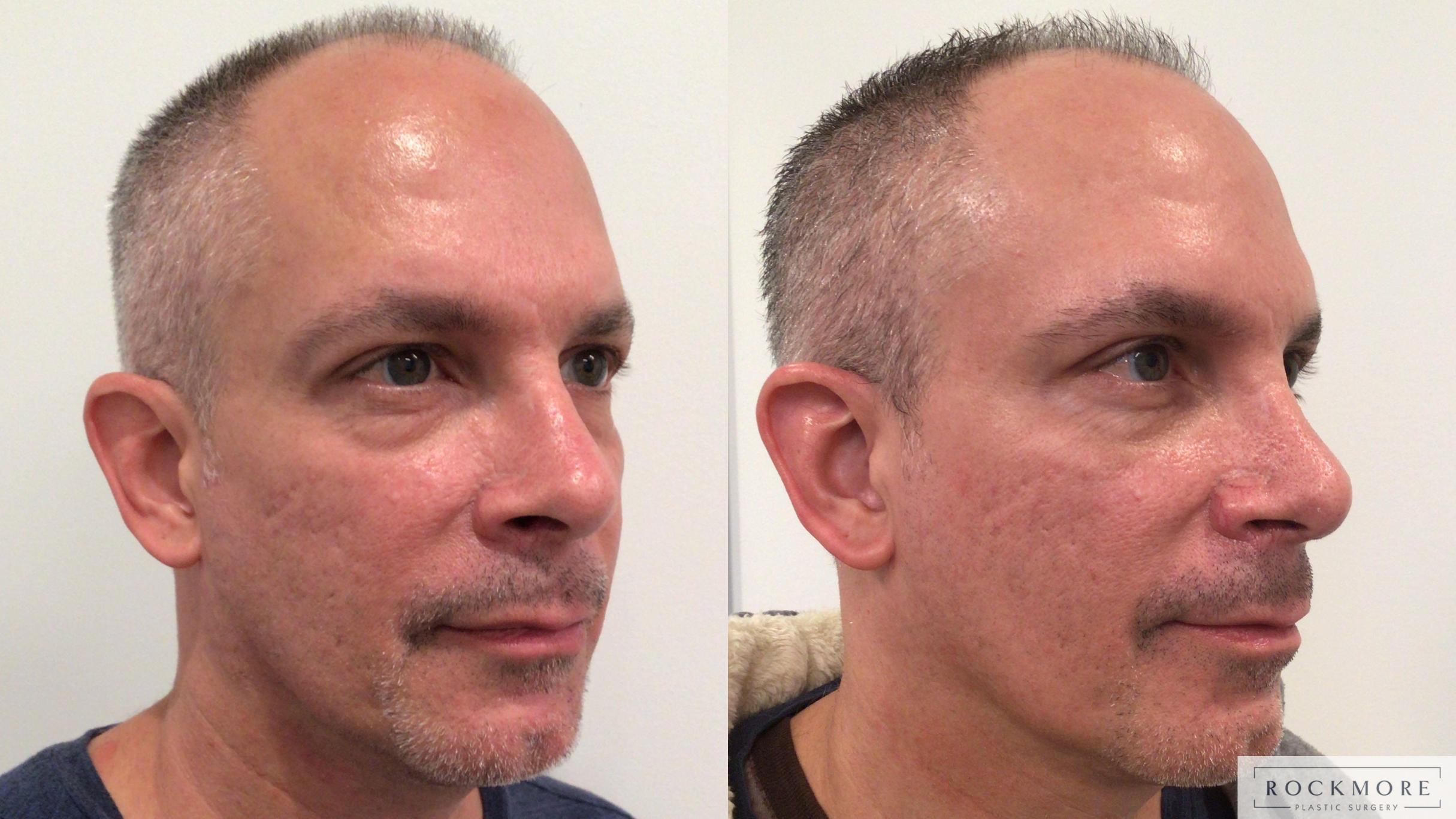 Before & After Rhinoplasty Case 443 Left Oblique View in Albany & Latham, New York