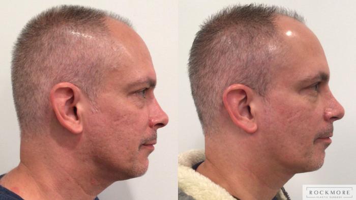 Before & After Rhinoplasty Case 443 Left Side View in Albany & Latham, New York
