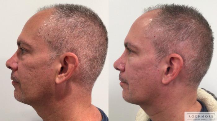 Before & After Rhinoplasty Case 443 Right Side View in Albany & Latham, New York