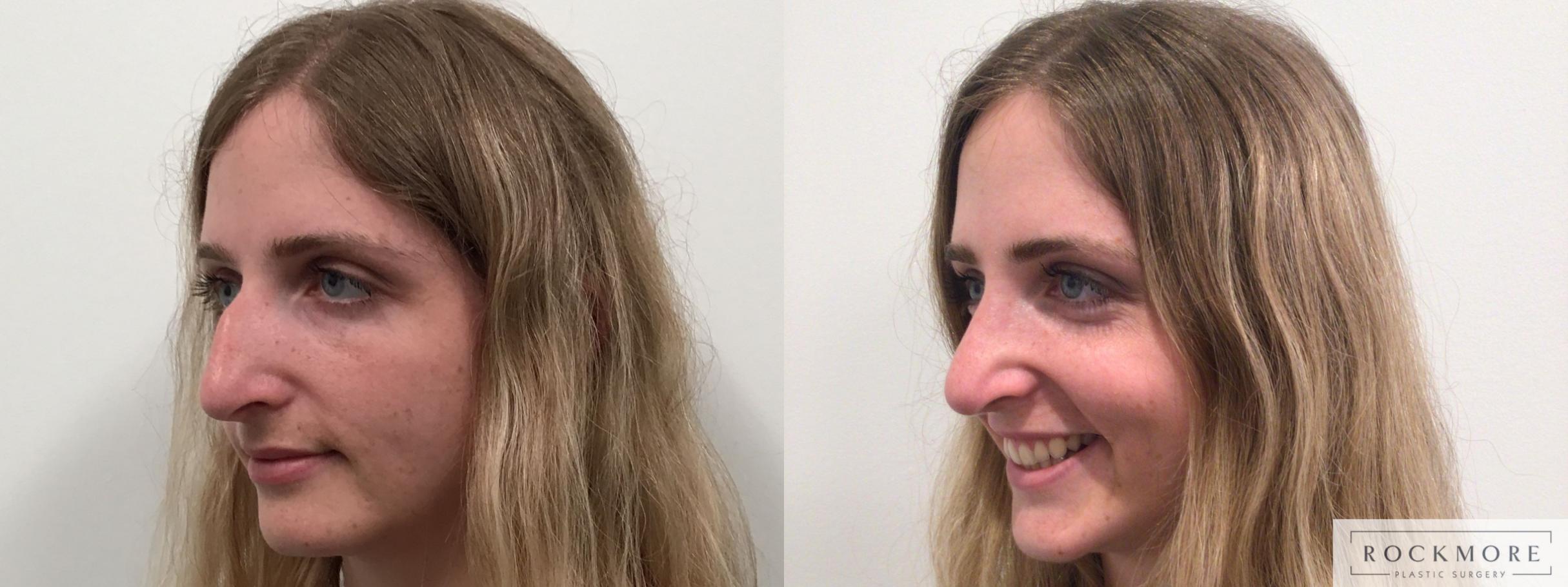 Before & After Rhinoplasty Case 453 Left Oblique View in Albany & Latham, New York