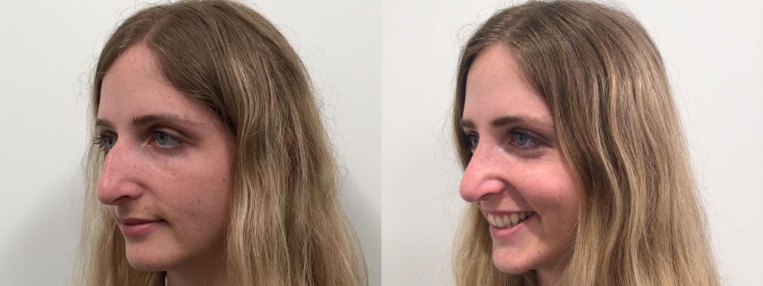 Before & After Rhinoplasty Case 453 Left Oblique View in Albany & Latham, New York