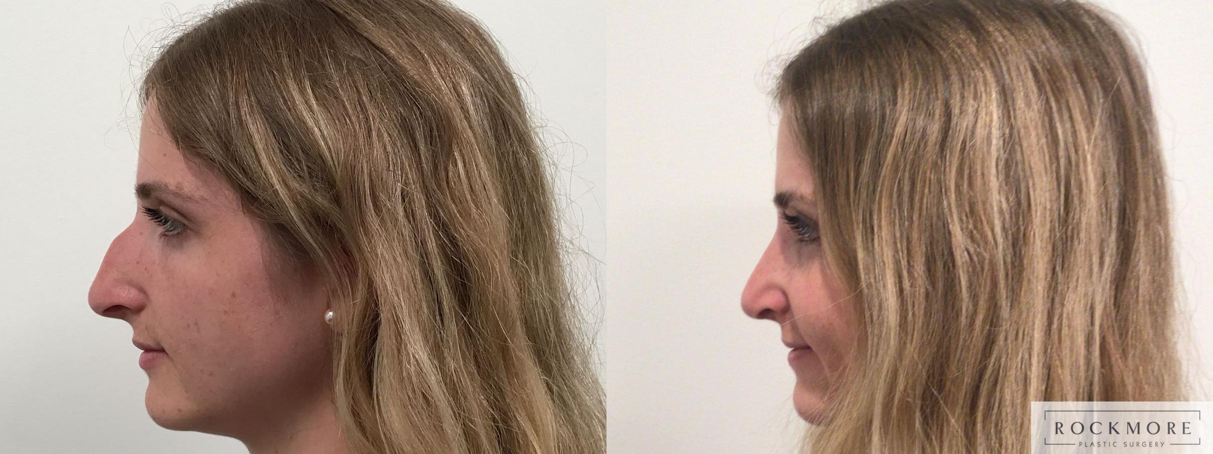 Before & After Rhinoplasty Case 453 Left Side View in Albany & Latham, New York