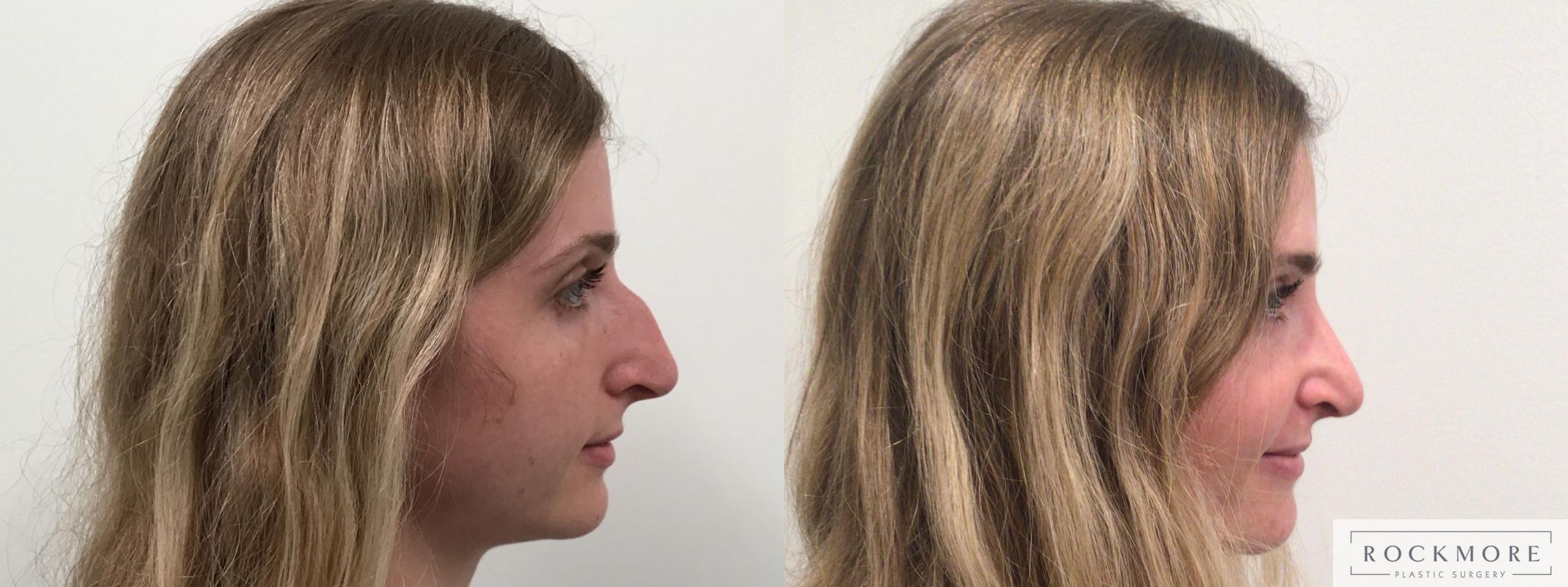 Before & After Rhinoplasty Case 453 Right Side View in Albany & Latham, New York