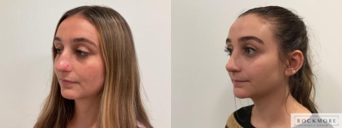 Before & After Rhinoplasty Case 456 Left Oblique View in Albany & Latham, New York