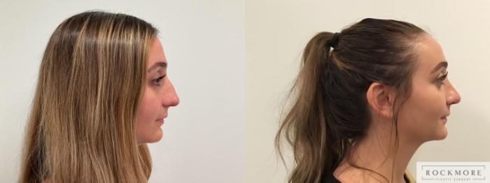 Before & After Rhinoplasty Case 456 Right Side View in Albany & Latham, New York