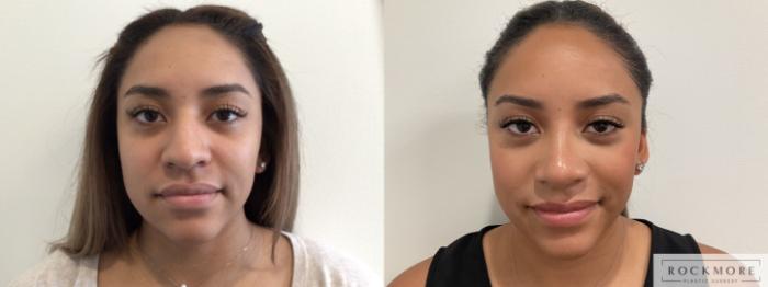 Before & After Rhinoplasty Case 468 Front View in Albany & Latham, New York