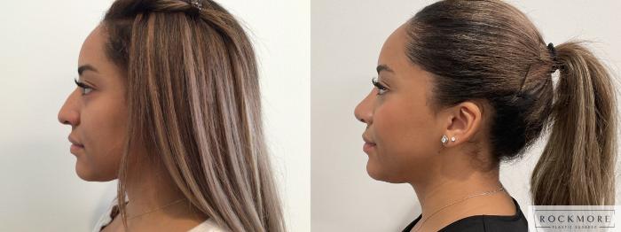 Before & After Rhinoplasty Case 468 Left Side View in Albany & Latham, New York