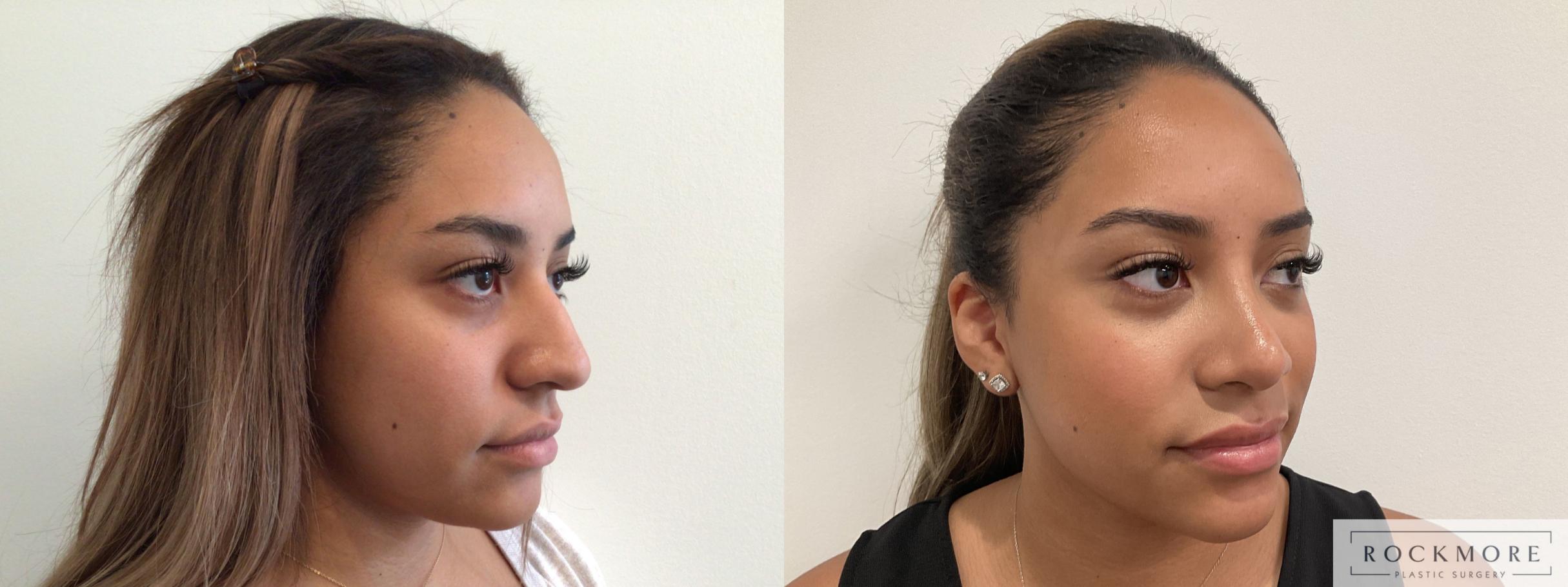 Before & After Rhinoplasty Case 468 Right Oblique View in Albany & Latham, New York