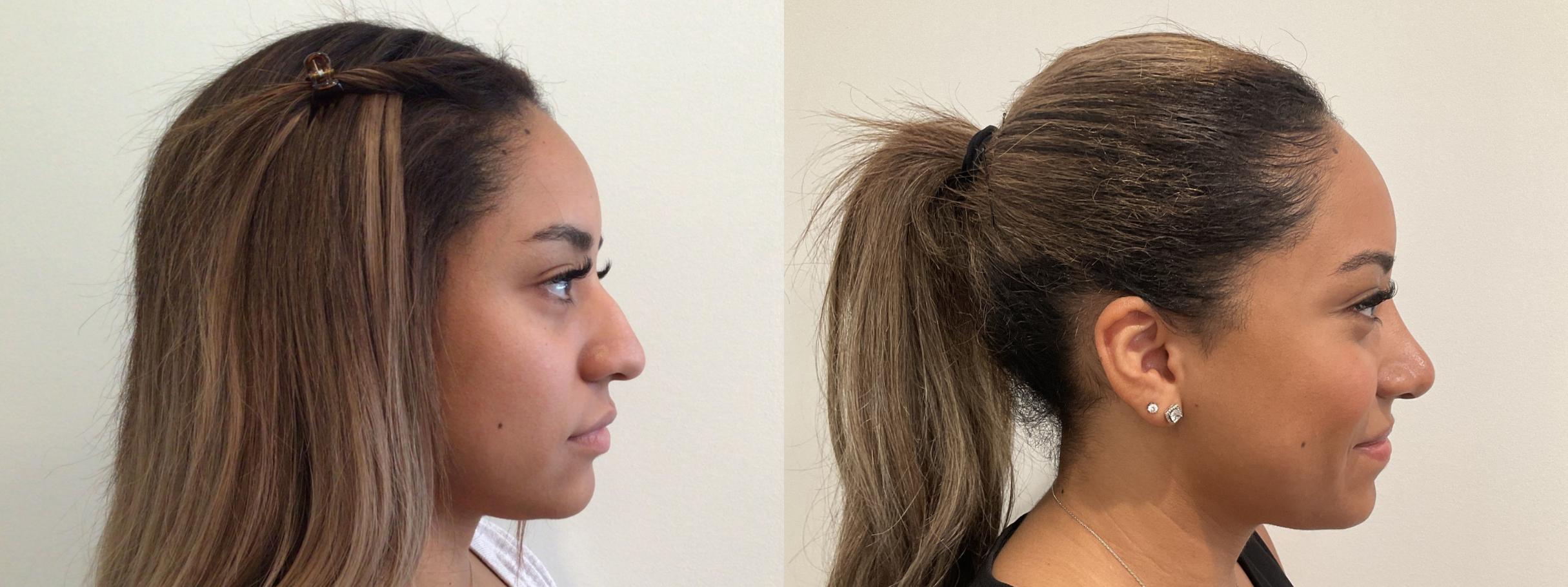 Before & After Rhinoplasty Case 468 Right Side View in Albany, Latham & Saratoga, New York