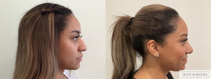 Before & After Rhinoplasty Case 468 Right Side View in Albany & Latham, New York