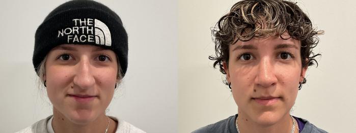 Before & After Rhinoplasty Case 481 Front View in Albany, Latham & Saratoga, New York