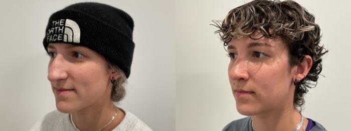 Before & After Rhinoplasty Case 481 Left Oblique View in Albany, Latham & Saratoga, New York