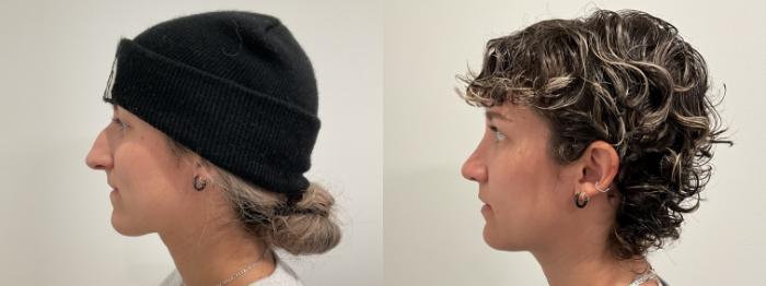 Before & After Rhinoplasty Case 481 Left Side View in Albany, Latham & Saratoga, New York