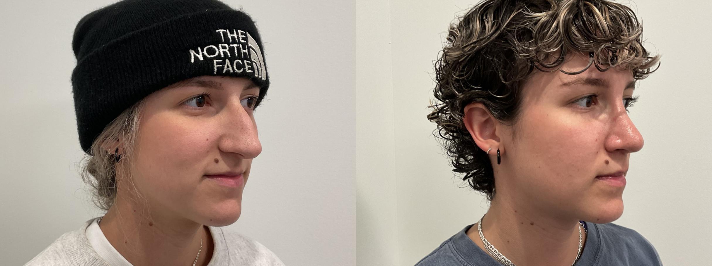 Before & After Rhinoplasty Case 481 Right Oblique View in Albany, Latham & Saratoga, New York