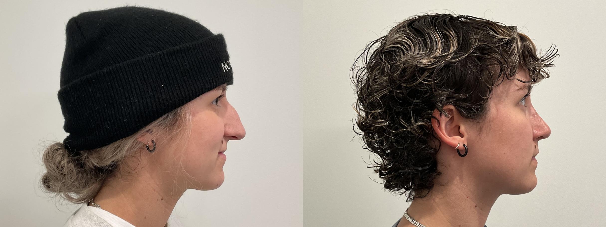 Before & After Rhinoplasty Case 481 Right Side View in Albany, Latham & Saratoga, New York