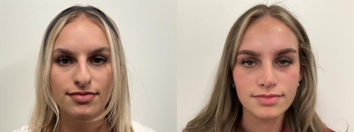 Before & After Rhinoplasty Case 496 Front View in Albany, Latham & Saratoga, New York