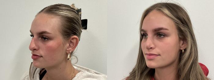Before & After Rhinoplasty Case 496 Left Oblique View in Albany, Latham & Saratoga, New York